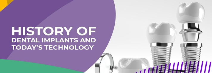 History Of Dental Implants And Today’s Technology